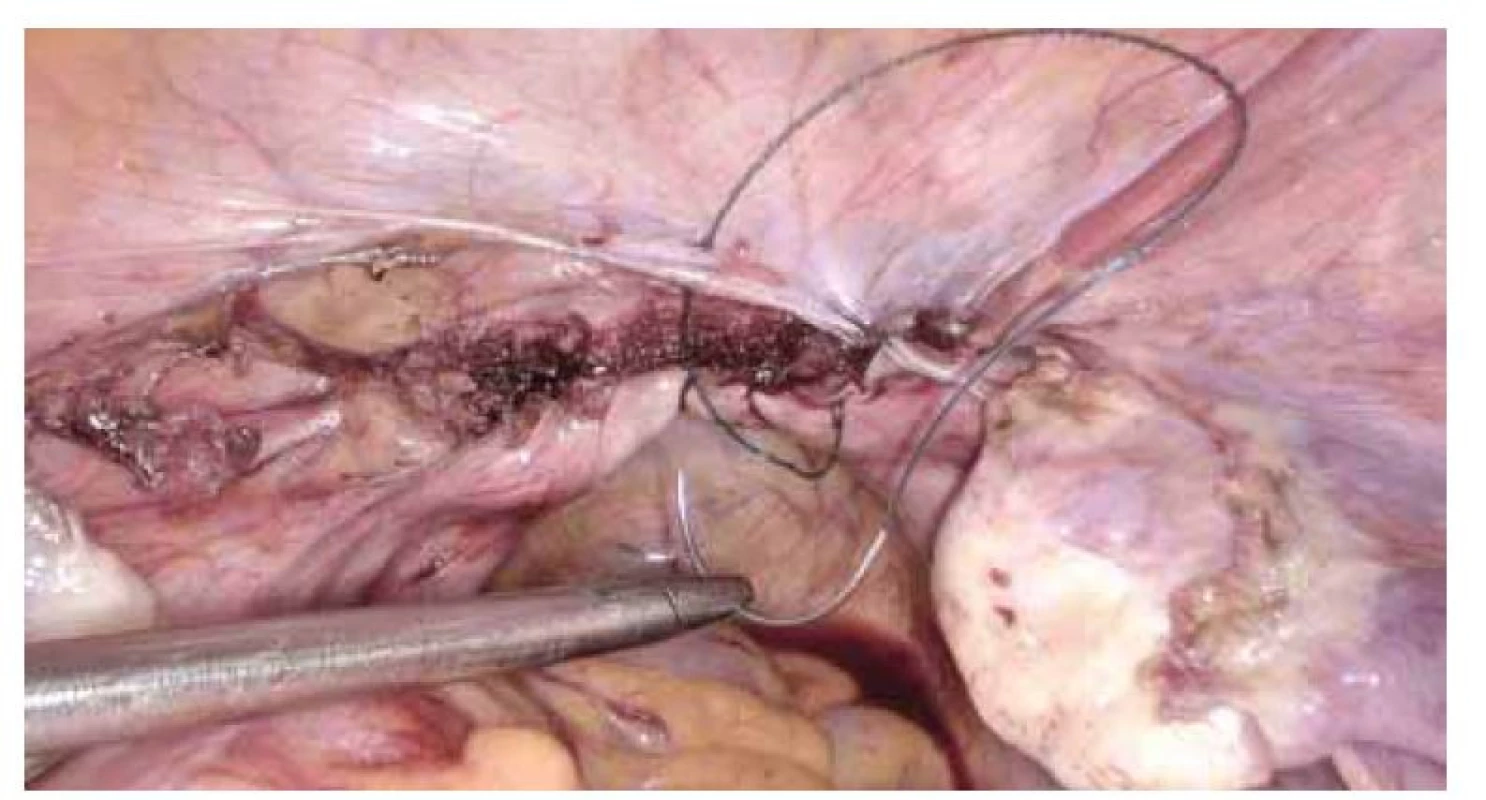 Sutura poševního pahýlu laparoskopicky s použitím V-lock stehu.<br>
Fig. 2. V-lock suture of the vaginal cuff .