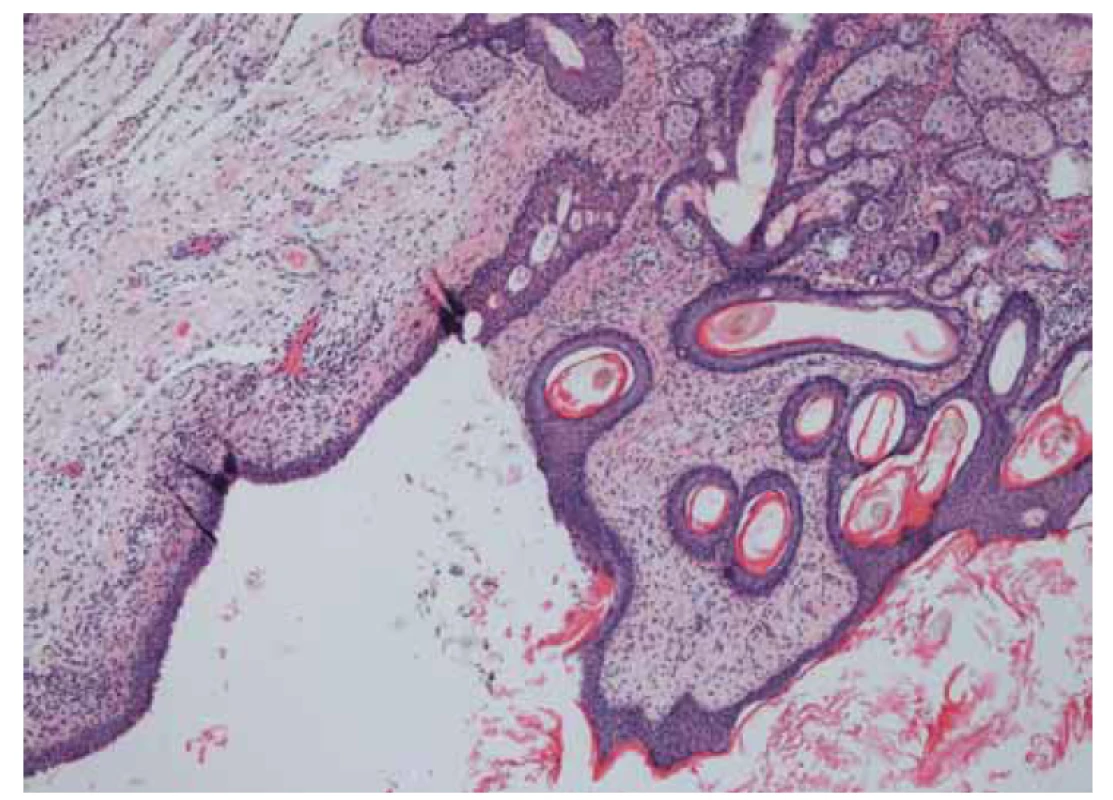 Zralý teratom s gliálnimi buňkami.<br>
Fig. 2. Mature teratoma with glial elements.