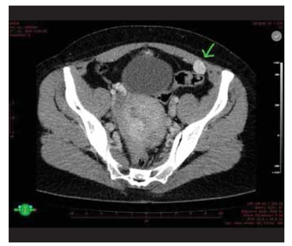 CT nález parazitárního leiomyomu uloženým retroperitoneálně
mezi přímým a šikmým svalem břišním.<br>
Fig. 1. CT finding of parasitic leiomyoma located retroperitoneally
between the rectus abdominus and the oblique abdominal
muscle.
