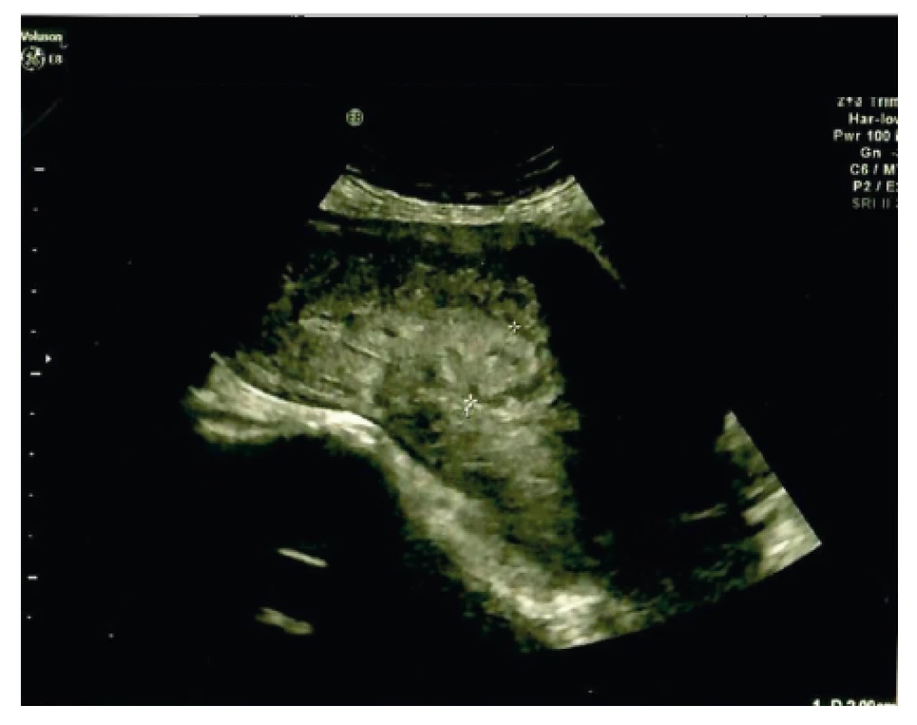 Ultrazvukové vyšetření čtvrtý den po porodu