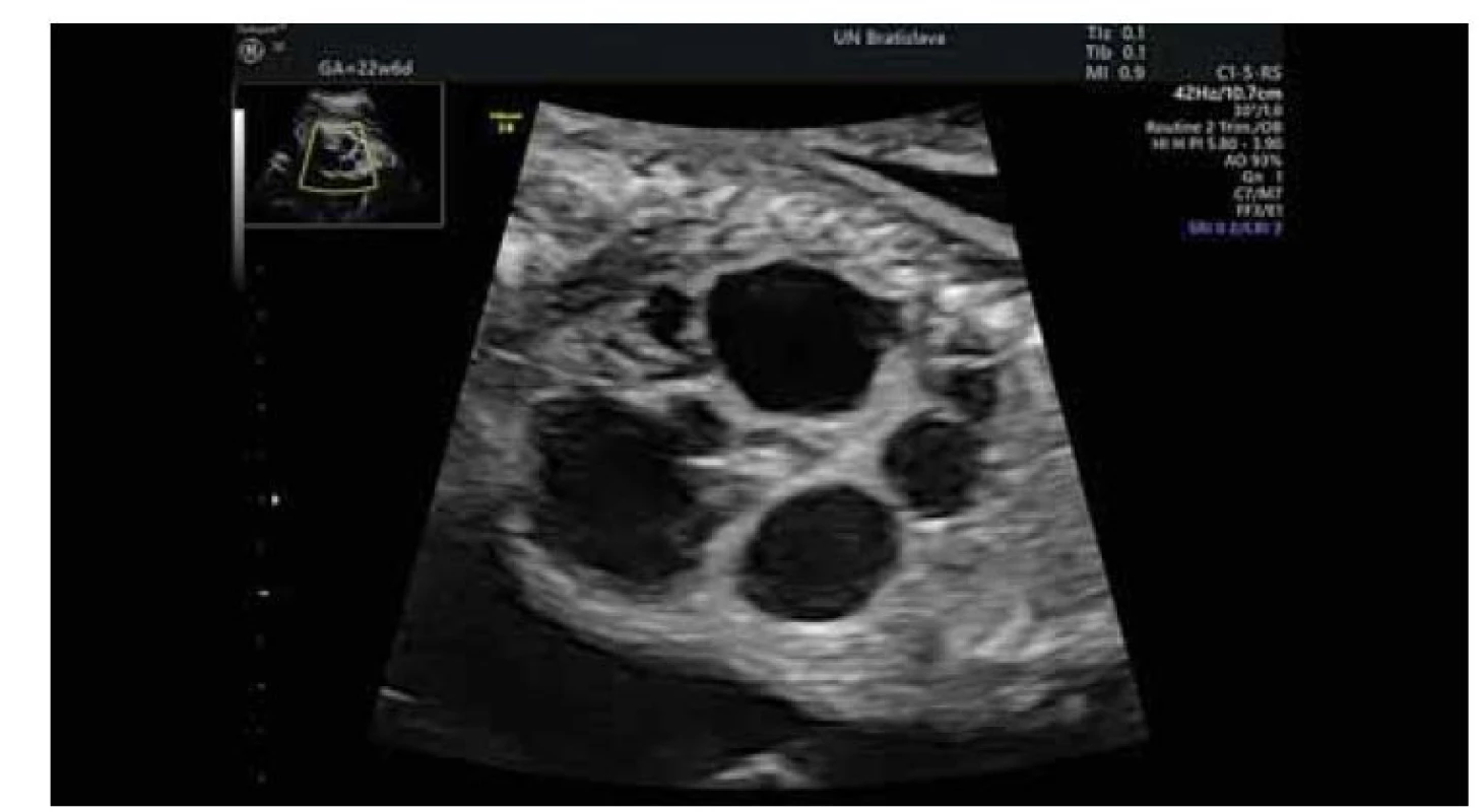 Plod v 23. týždni gestácie – midsagitálny ultrasonografický pohľad na
makrocystickú štruktúru obličkového parenchým, ktorý vypĺňa takmer celú
brušnú dutinu plodu.<br>
Fig. 2. Fetus in the 23rd week of gestation – midsagittal ultrasonographic view of
the macrocystic structure of the renal parenchyma, which fills almost the entire
abdominal cavity of the fetus.