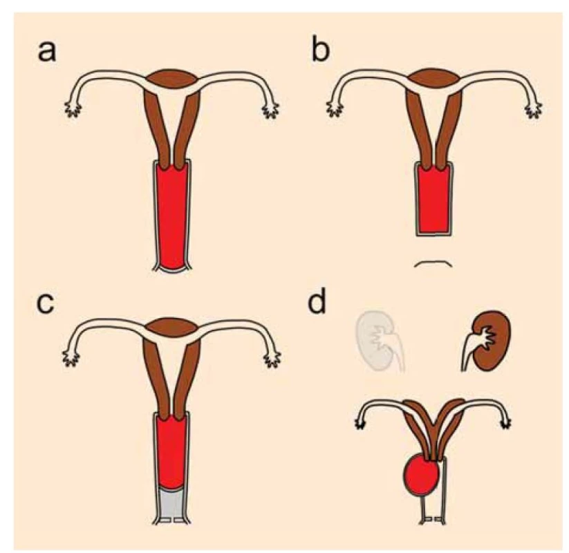 Vrozené vady urogenitálního traktu způsobující hematokolpos. Nahromaděná
krev v pochvě je zbarvena do červena.<br>
a – atrezie hymenu, b – distální vaginální ageneze, c – transverzální vaginální septum,<br>
d – obstrukční hemivagina a ipsilaterální anomálie ledviny [1].<br>
Fig. 2. Congenital urogenital anomalies causing hematocolpos. The accumulated
blood in the vagina is colored red [1].<br>
a – hymen atresia, b – distal vaginal agenesis, c – complete transverse vaginal septum,<br>
d – obstructed hemivagina and ipsilateral renal anomaly.