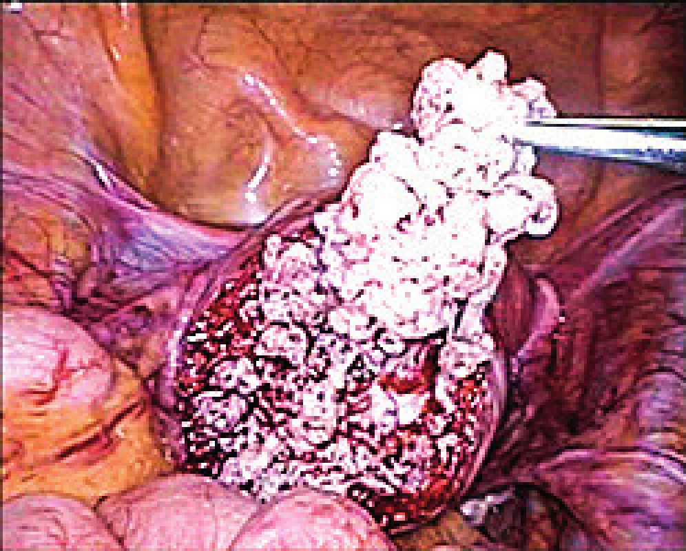 Peri-operatively suspicious tumor of uterine muscularity
(verified later as leiomyoma with bizarre nuclei) during
laparoscopic removal using endobag