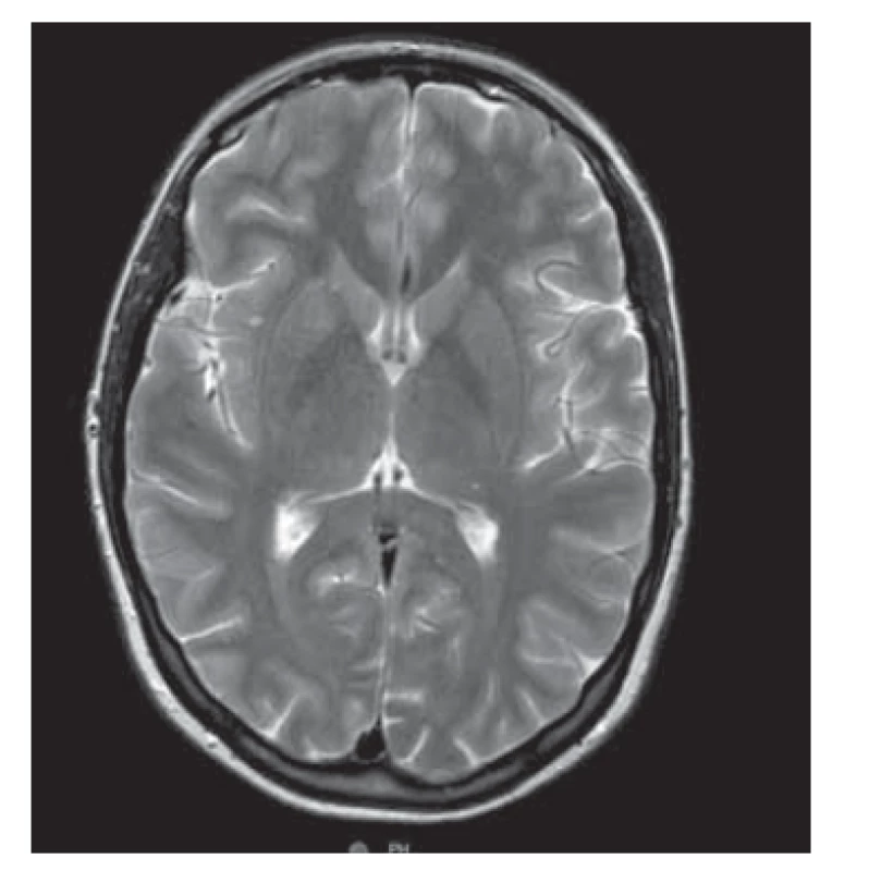 Nativní MR mozku a MR angiografie 
u pacientky s nálezem ischemických
fokusů v oblasti bazálních
ganglií, v mozečku a bilaterálně temporálně
v souvislosti s opakovanými
atakami křečí v rámci eklampsie (půl
roku od eklampsie).<br>
Fig. 2. Native brain MR and MR angiography
findings in a patient with ischemic
foci in the basal ganglia, cerebellum,
and temporal lobe bilaterally in
the context of repeated attacks of convulsions
within eclampsia (half a year
since eclampsia).