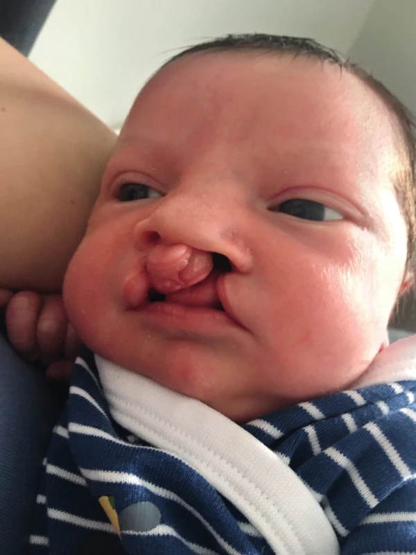 Novorozenec před korekční operací