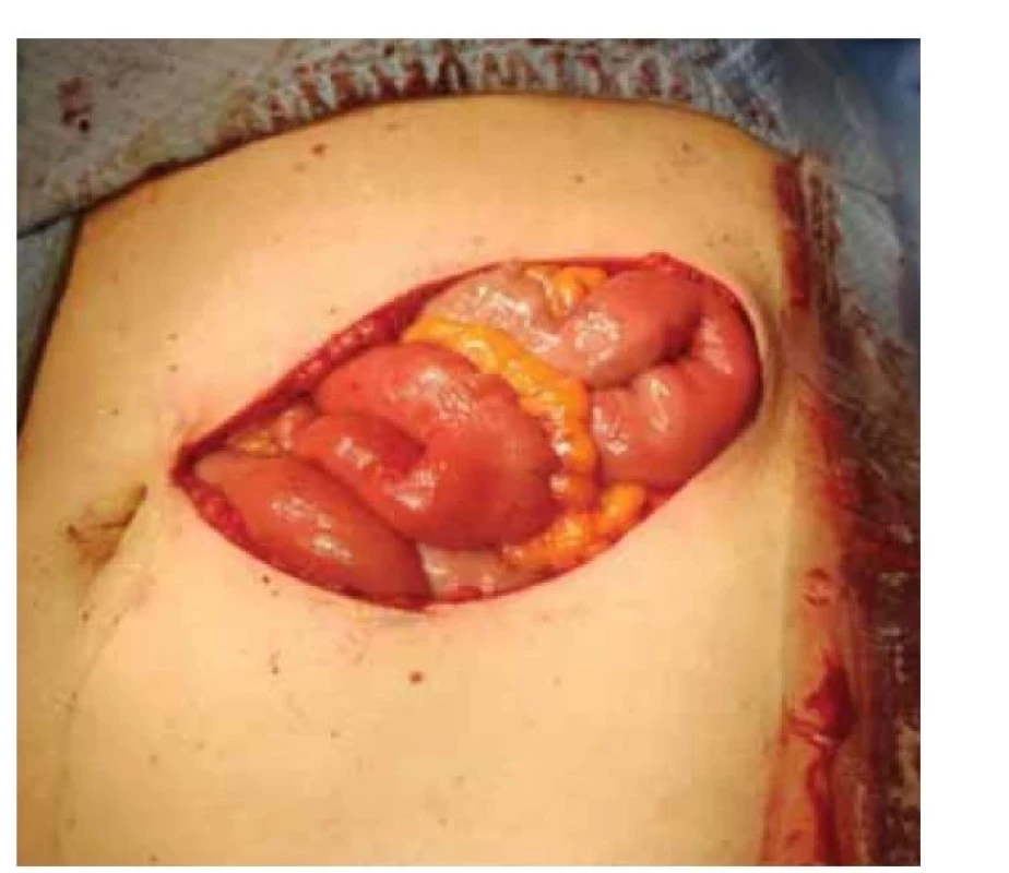 Stav po resekci recidivy karcinomu endometria
v břišní stěně.<br>
Fig. 2. Condition after resection of endometrial carcinoma
recurrence in the abdominal wall.