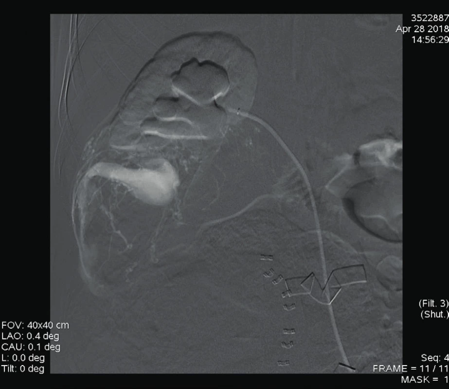 Digitální subtrakční angiografie a. renalis dextra: zobrazuje
se patologická vaskularizace angiomyolipomu s AV zkratem
s ektatickou odvodnou žilou [6]