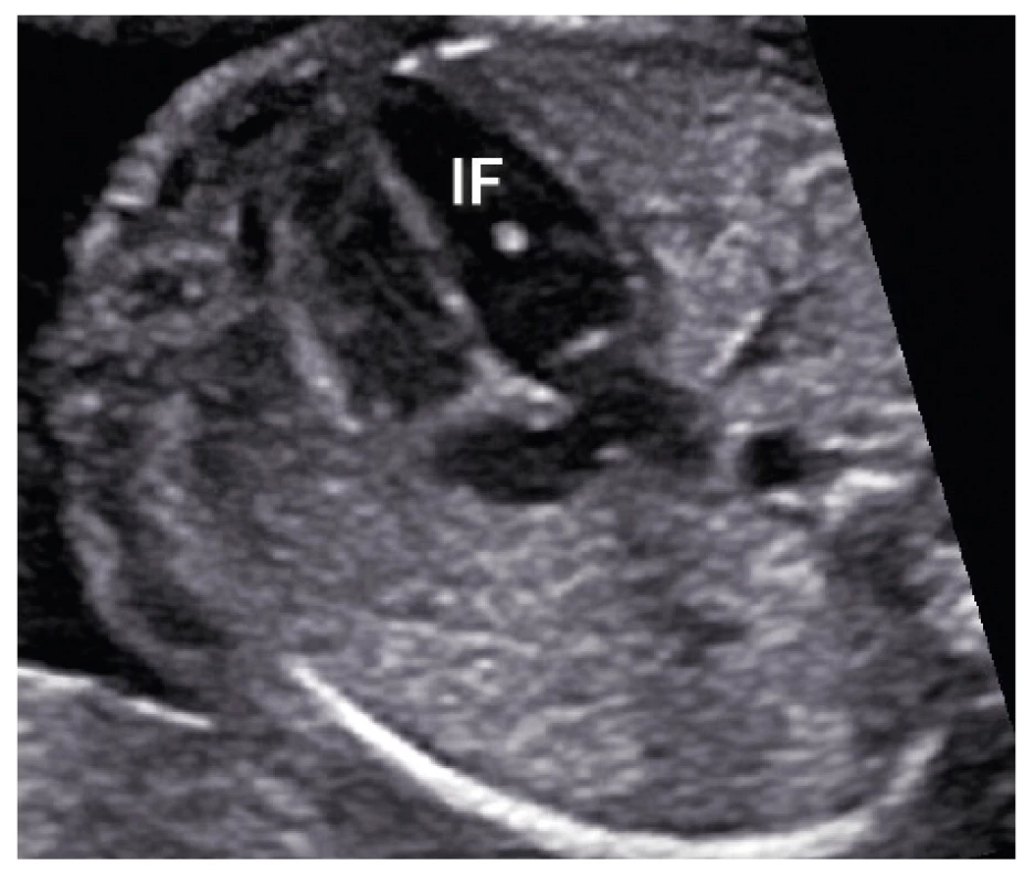 Ultrazvukový nález nevýznamného echogenního fokusu
(IF) v levé komoře