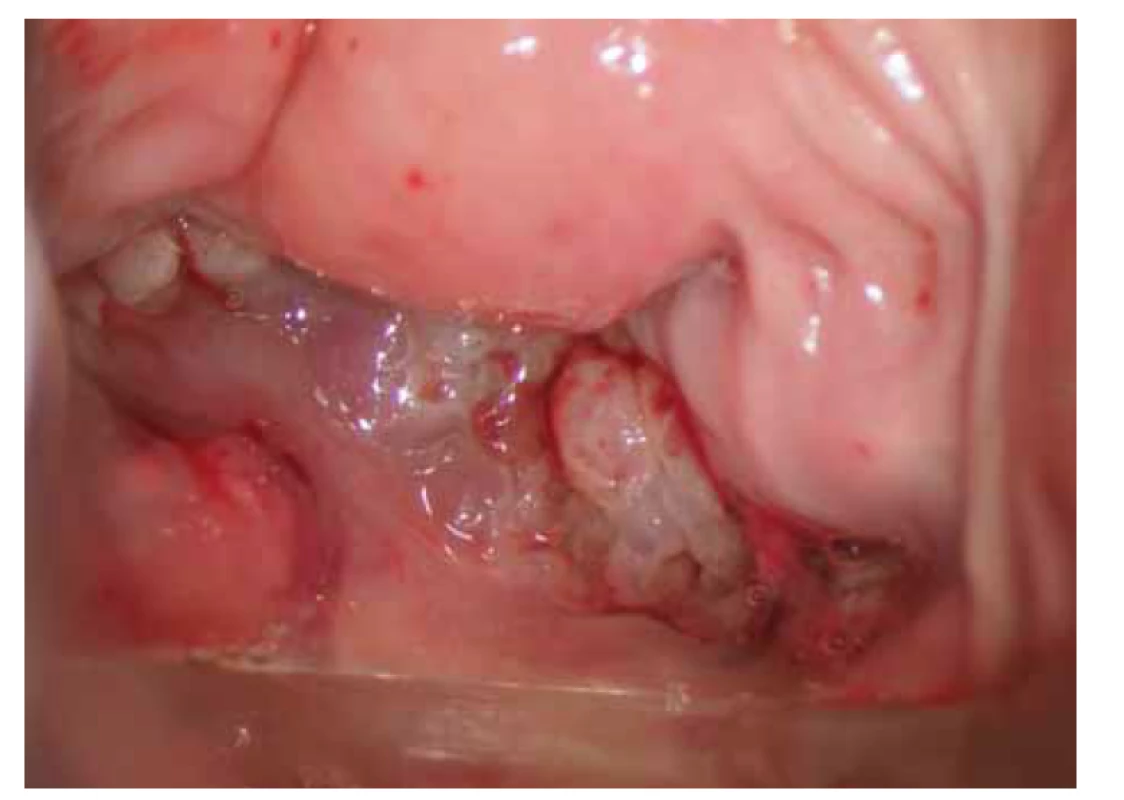 Kolposkopický obraz – 4. měsíc užívaní antituberkulotik.<br>
Fig. 4. Colposcopic examination – 4th month of antituberculosis treatment.
