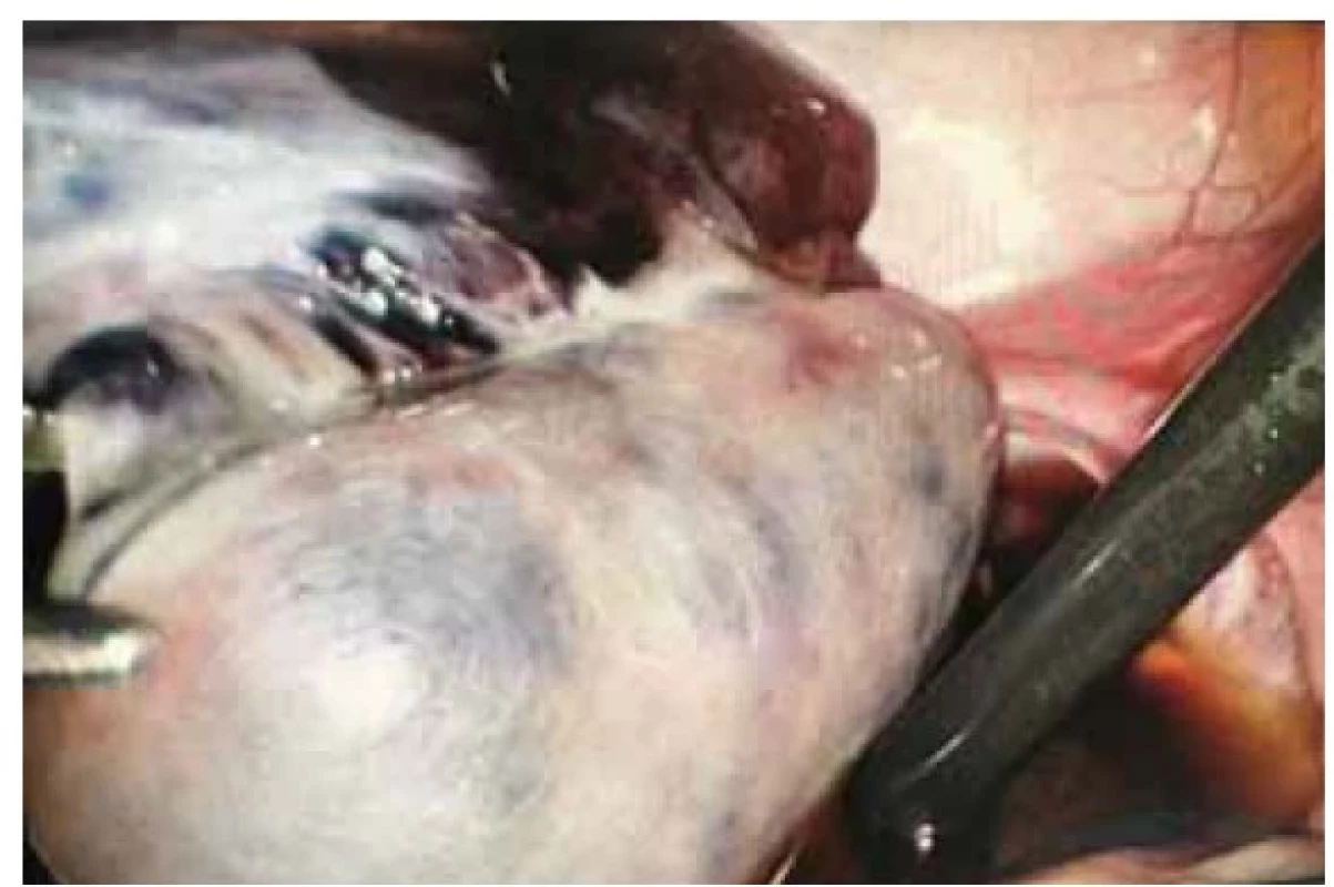 Torze levých adnex s volnou tekutinou v okolí,
malá děloha vpředu.<br>
Fig. 1. Torsion of the left adnexa with free fluid around, small
uterus in front.