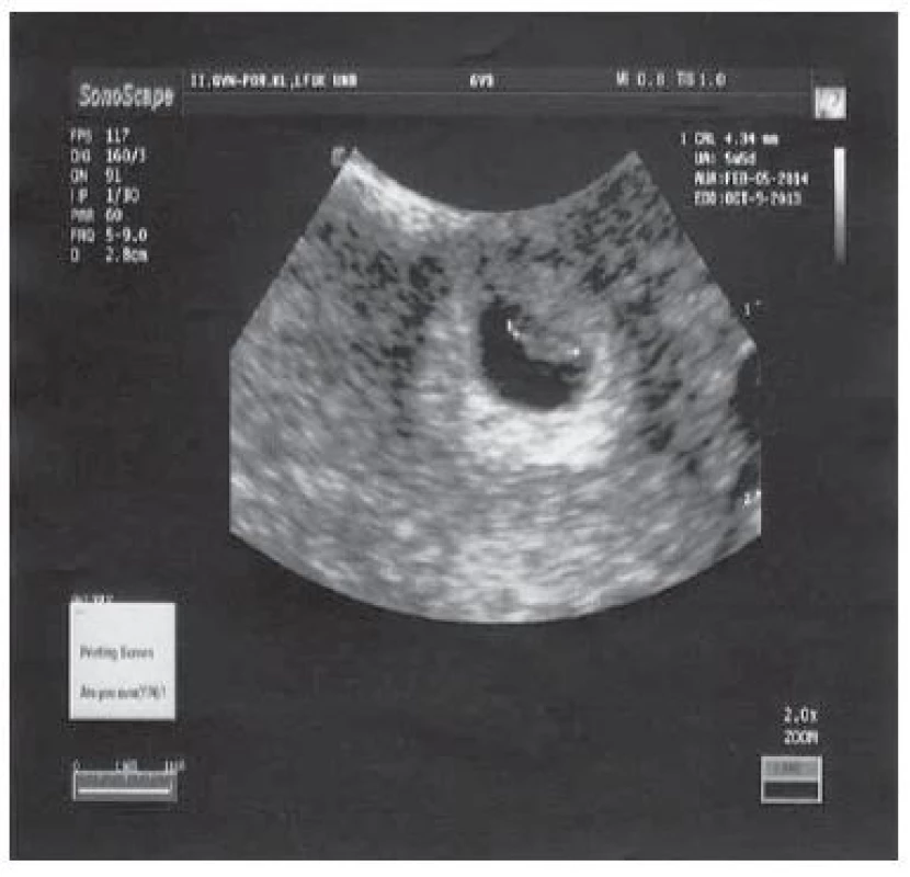 Detailný pohľad na gestačný vak s vitálnym embryom, foto autori. </br> Detailed view of a gestational sac with a vital embryo, photo by the authors.