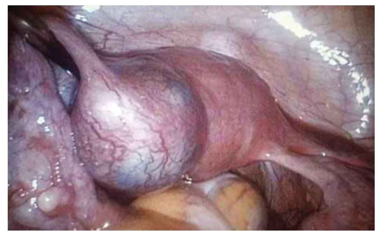 Perioperační nález intersticiální gravidity.<br>
Fig. 2. Perioperative finding of interstitial ectopic pregnancy.