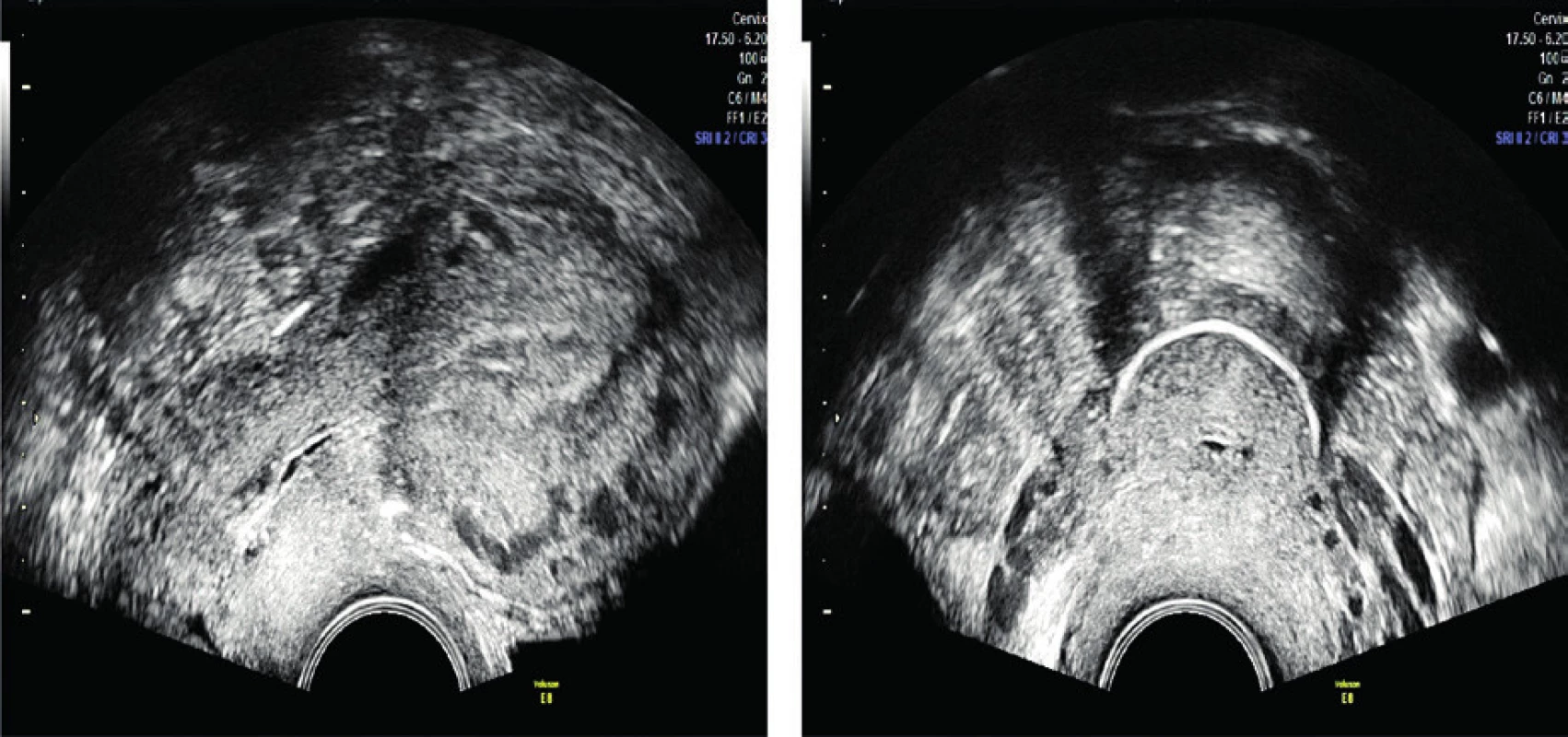 Ultrasound verification of correct placement of the
cerclage after the procedure in the first case