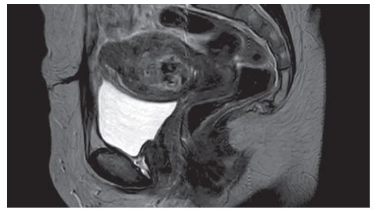 Léze EMV při MR vyšetření.<br>
EMV – vysoce vaskularizovaná léze myometria, MR – magnetická rezonance<br>
Fig. 3. EMV lesion on MRI examination.