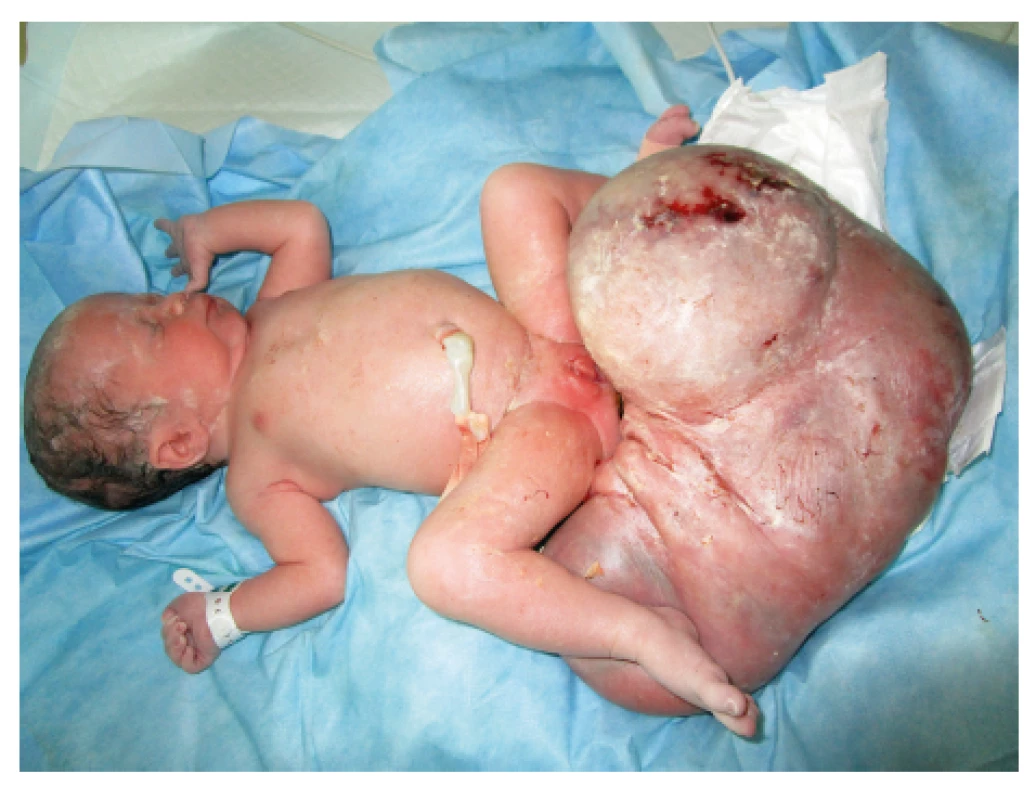 Dívka s masivním sakrokokcygeálním teratomem časně po
porodu s uvolňovací punkcí útvaru