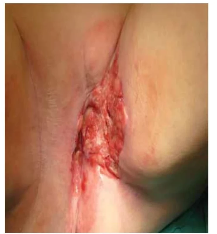 Lokálně rozsáhlá recidiva spinocelulárního karcinomu
vulvy.<br>
Fig. 5. Locally extensive recurrence of squamous cell carcinoma
of the vulva.