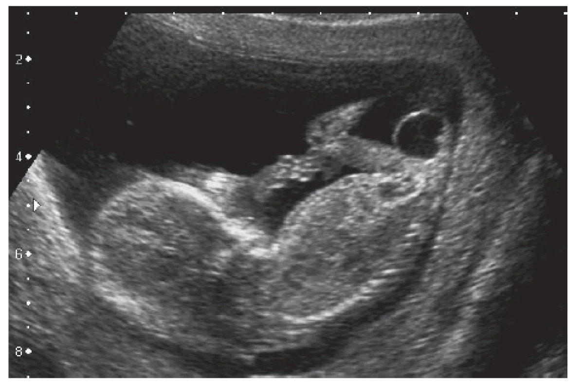 Prvotrimestrální screeningové ultrazvukové vyšetření
s nálezem sakrokokcygeální expanze