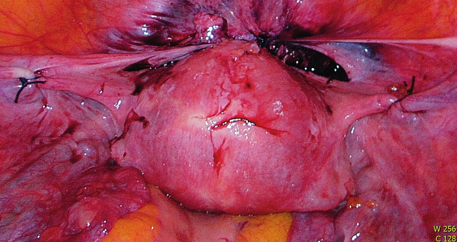 Konečný výsledek operace – laparoskopická resekce a resutura dolního děložního segmentu + ventrosuspenze