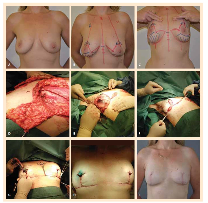 Okamžitá rekonstrukce prsou u pacientky s BRCA1/2 mutací a tumorem prsu vpravo. Proveden kombinovaný výkon
zahrnující kůži šetřící mastektomii s okamžitou rekonstrukcí implantáty, vytvoření neobradavek pomocí místního
laloku a laparoskopické odstranění vaječníků.<br>
Fig. 3. Immediate breast reconstruction in a patient with BRCA1/2 mutation and right breast tumor. Performed combined
procedure including skin-saving mastectomy with immediate reconstruction with implants, creation of non-nipples using
a local lobe and laparoscopic removal of the ovaries.