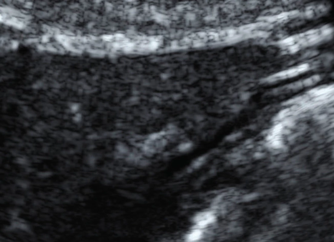 Ultrasound image of ruptured implant
