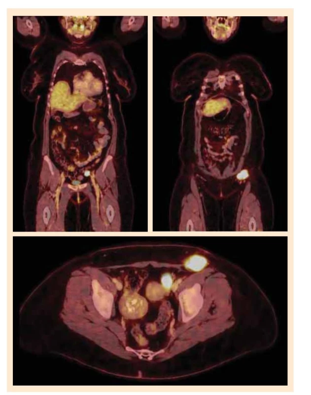 Celotělové PET/CT s přítomností suspektní viabilní nádorové tkáně v levém
třísle a v oblasti levého ovaria.<br>
Fig. 1. Whole-body PET/CT with the presence of suspected viable tumor tissue in
the left groin and in the area of the left ovary.