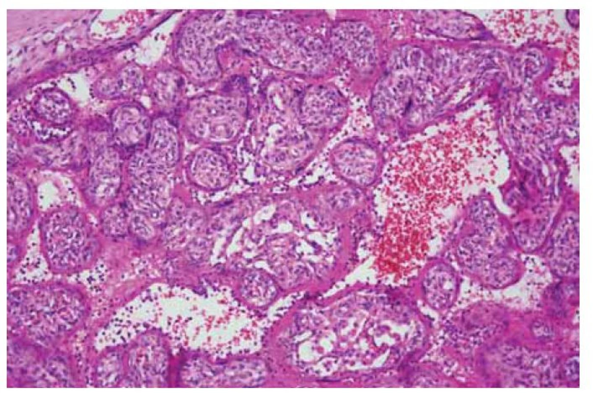 Choriové klky s nekrózami vilózního trofoblastu obklopené fibrinoidem,
v intervilózních prostorách je přítomen zánětlivý infiltrát tvořený histiocyty
a neutrofilními granulocyty (HE, 200x).<br>
Fig. 4. Chorionic villi with necrosis of a villous trophoblast surrounded by fibrinoid,
inflammatory infiltrate consisting of histiocytes and neutrophilic granulocytes in
the intervillous spaces (HE, 200x).