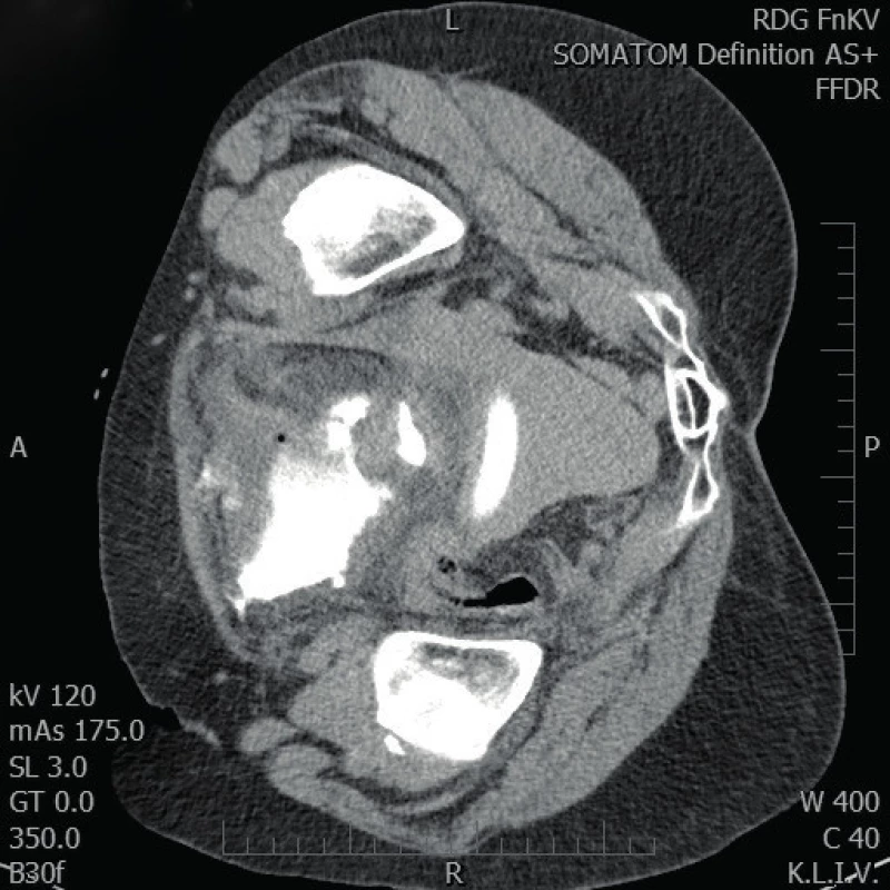 CT vyšetření – kolekce moči a kontrastní látky před
močovým měchýřem a podél vzestupného tračníku