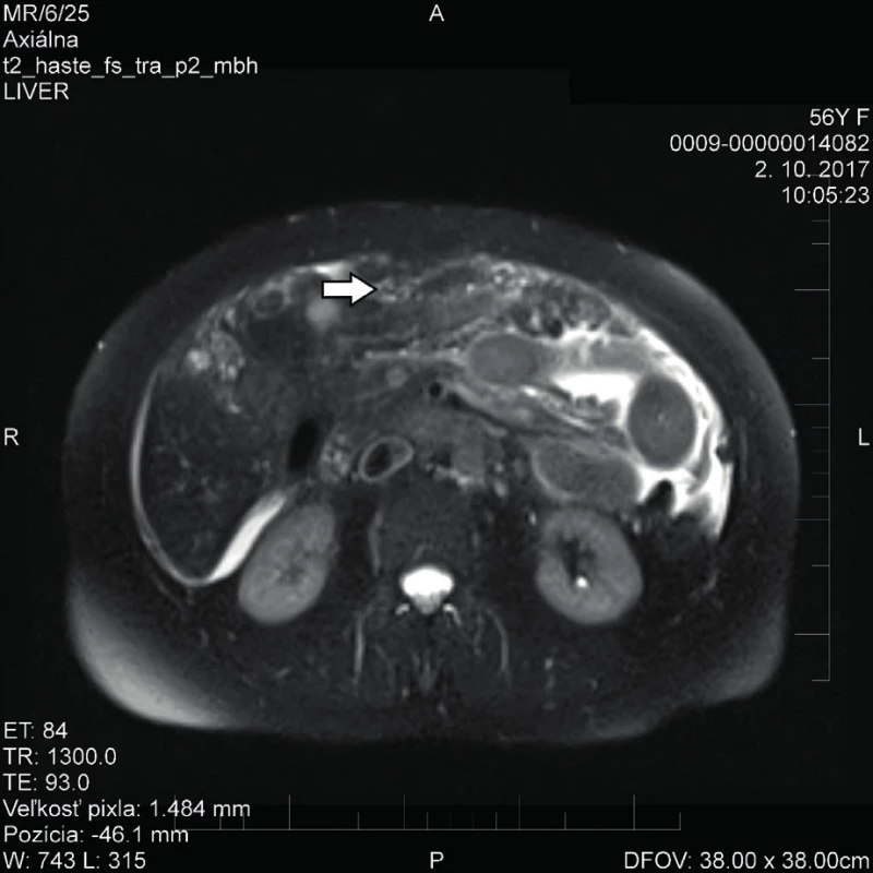 MR vyšetření s karcinomatózou a ascitem
