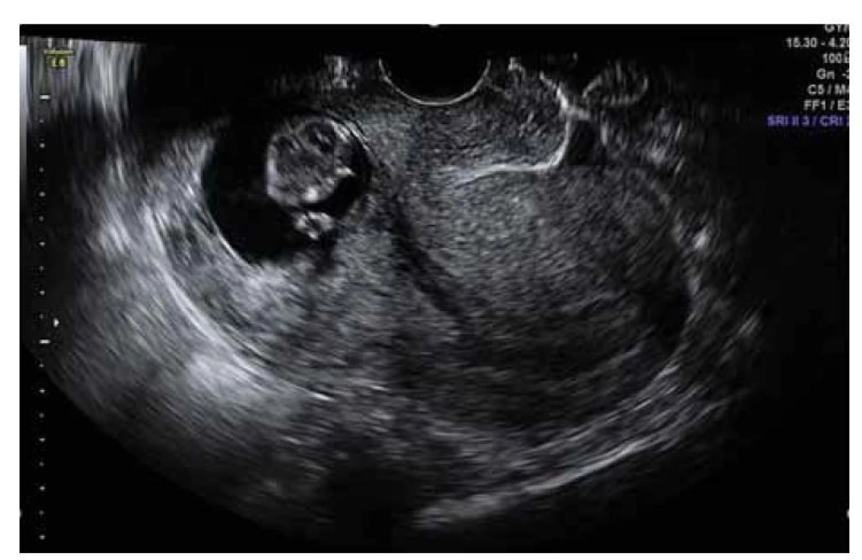 Ultrazvukový nález gravidity gestačního týdne 7+1 v jizvě děložní.
Atypicky nízko lokalizovaná gravidita. Prázdná horní polovina dutiny děložní.
Ztenčelé myometrium v místě nidace plodového vejce.<br>
Fig. 1. Ultrasound finding of gestational week 7+1 pregnancy in a uterine scar.
Atypically low localized pregnancy. The empty upper half of the uterine cavity.
Thinned myometrium at the site of fetal egg nidation.