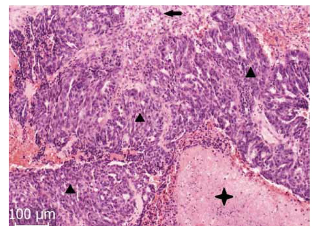 Solidní oblasti (▲) nádorového epitelu ve vazivém stromatu (←).
Viditelné jsou i oblasti nekrózy (✦).<br>
Fig. 2. Solid regions (▲) of the tumor epithelium in the fibrous stroma (←).
Areas of necrosis are also visible (✦).