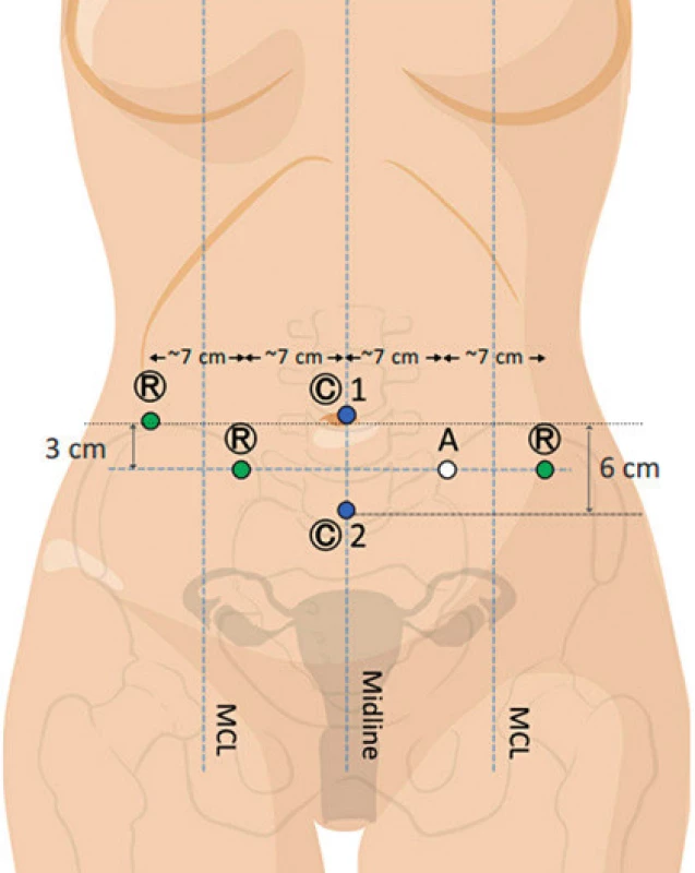 Duální dokování – rozmístění vstupů do břišní dutiny při
využití dvou vstupů pro optiku (upraveno podle Intuitive Surgical,
H. Falconer)