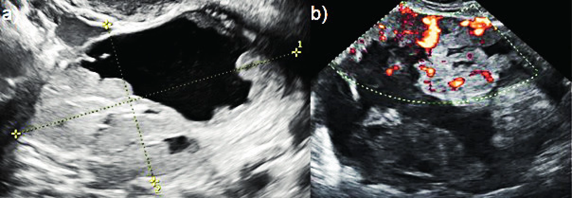 Srovnání benigního a maligního tumoru v terénu
endometriózy<br>
(a) decidualizovaná endometroidní cysta u těhotné ženy (přerušované
čáry); (b) ovariální endometroidní adenokarcinom vzniklý maligní
transformací endometroidní cysty u perimenopauzální pacientky.