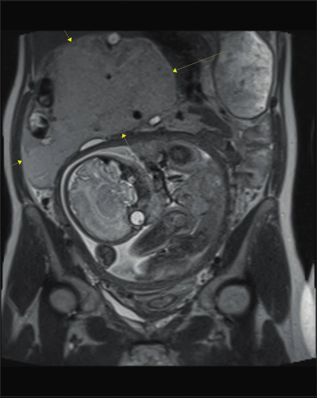 MRI dutiny břišní: předoperační rozsah angiomyolipomu,
v porovnání s velikostí dělohy [6]