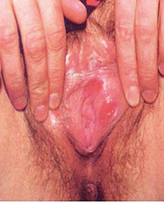 Syphilis primaria – ulcus durum (foto autor) se nejčastěji
jeví jako indurovaná nebolestivá eroze s matnou růžovočernou
lesklou spodinou, s typickou serózní exsudací při kompresi. Léze je
provázena zvětšením spádových lymfatických uzlin.