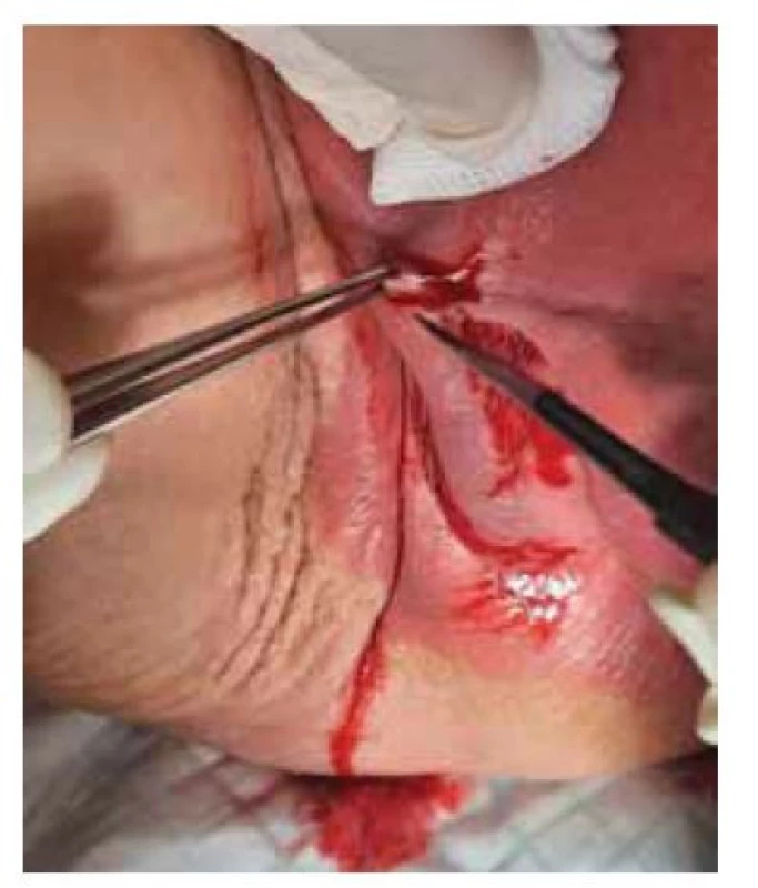 Odběr biopsie v lokální
anestezii.<br>
Fig. 2. Vulvar biopsy under local
anaesthesia.
