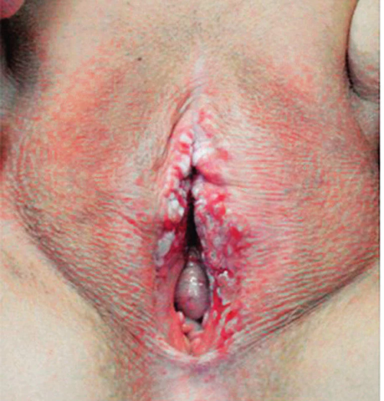 Carcinoma spinocellulare (foto autor) je maligní epitelový
nádor. Léze se manifestuje jako zatvrdlé plaky nebo vředy na vulvě
s možnými květákovitými exofyty. Související symptomy zahrnují
bolest, svědění a přerušované krvácení.