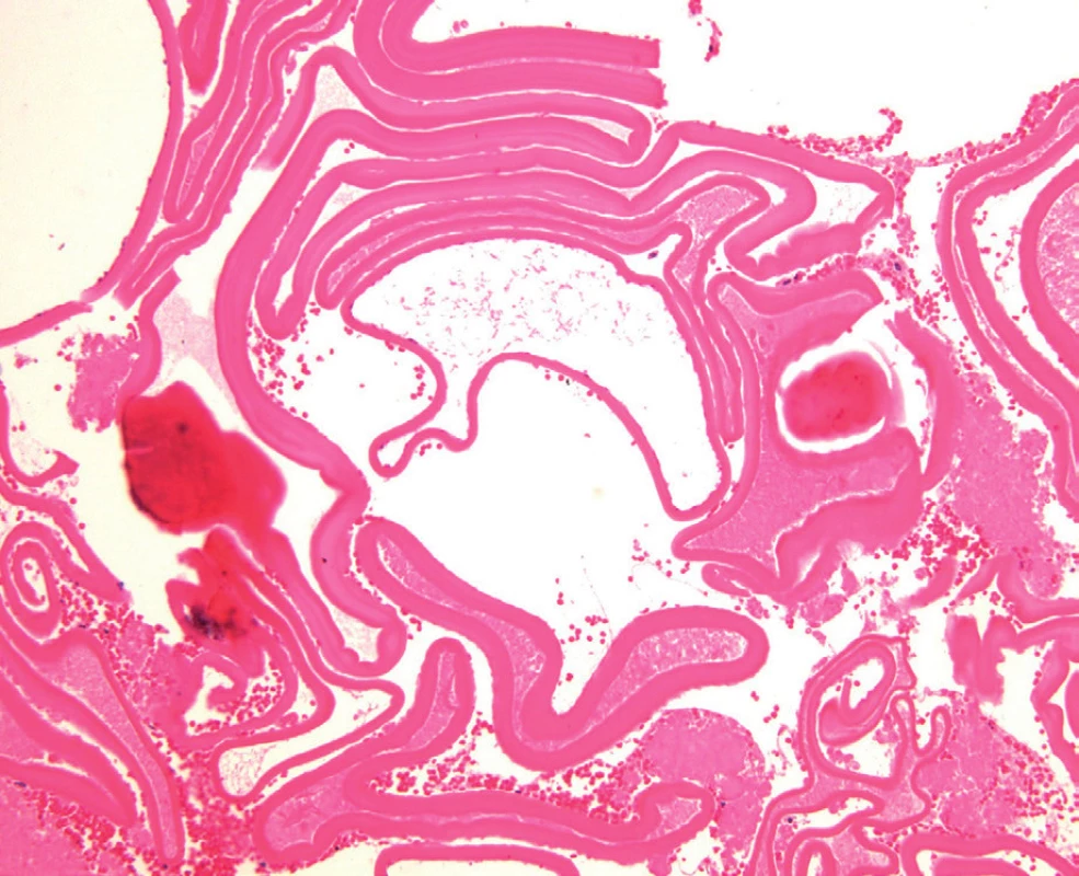 Histopatologie: lamelární struktura stěny echinokokové cysty; barvení HE, zvětšení 100krát