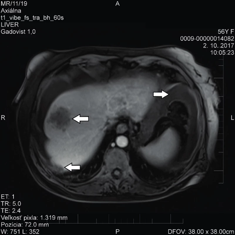 MR vyšetření, šipky ukazují dvě neostře ohraničená ložiska v játrech a okolní ascites 