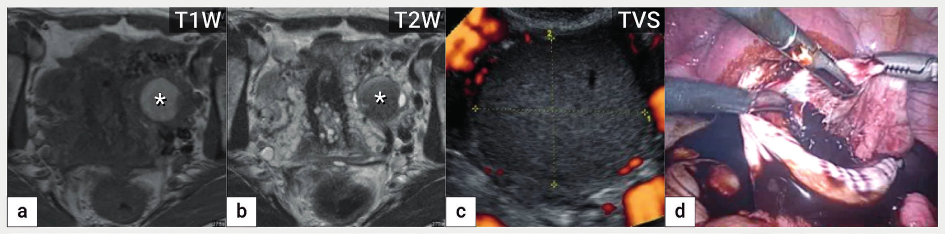 Endometroidní cysta<br>
Zobrazení endometroidní cysty v magnetické rezonanci na podkladě přítomnosti rozpadových produktů hemoglobinu, která je v T1 váženém
obrazu hyperintenzní (zvýšený signál) (a) a v T2 váženém obraze hypointenzní (tzv. shading) (b), v ultrazvukovém zobrazení patrná avaskulární
unilokulární cysta s denzní hypoechogenní intracystickou tekutinou (c) a intraoperační nález z laparoskopické cystektomie (d).
T1W a T2W – T1 a T2 vážené obrazy v magnetické rezonanci, TVS – transvaginální sonografie