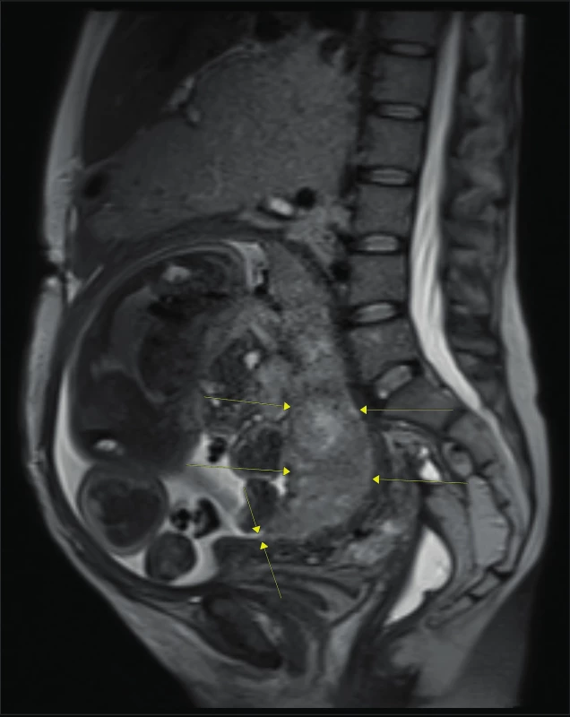 MRI dutiny břišní: placenta marginalis dosahující ze zadní
stěny k vnitřní brance [6]