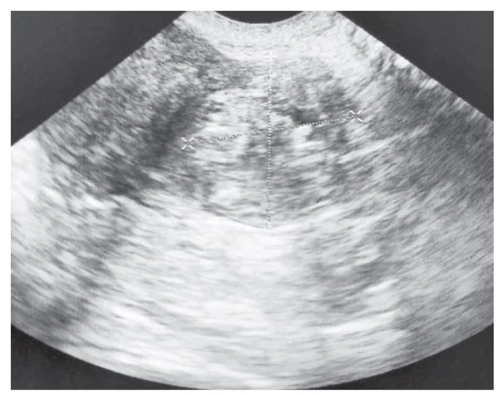 Ultrazvukové vyšetření zobrazující intersticiální graviditu.<br>
Fig. 1. Ultrasound examination showing interstitial ectopic pregnancy.
