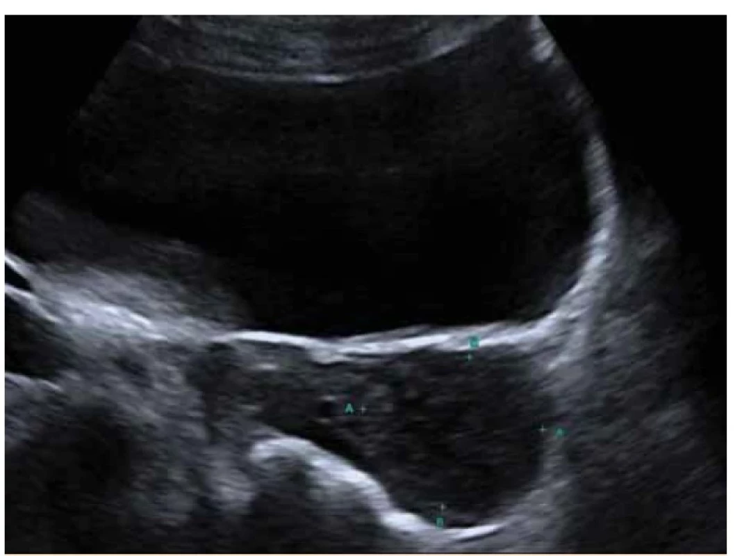 Ultrazvukový obraz torkvovaného ovaria s edémem ovariální tkáně.<br>
Fig. 3. Ultrasound image of torqued ovary with ovarian tissue edema.