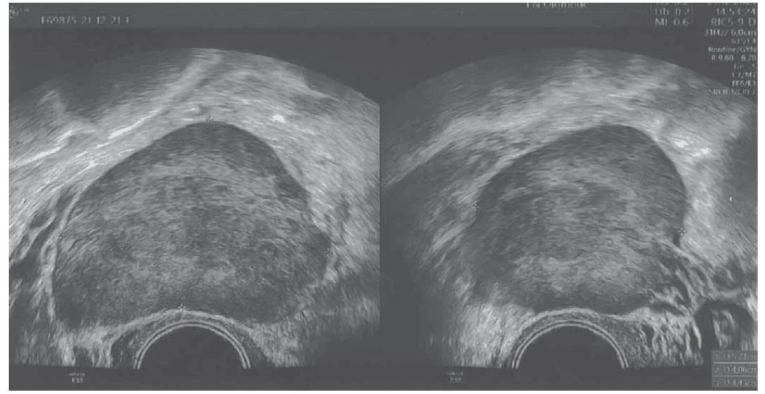 Předoperační ultrazvukové zobrazení tumoru.<br>
Fig. 1. Preoperative ultrasound imaging of the tumor.