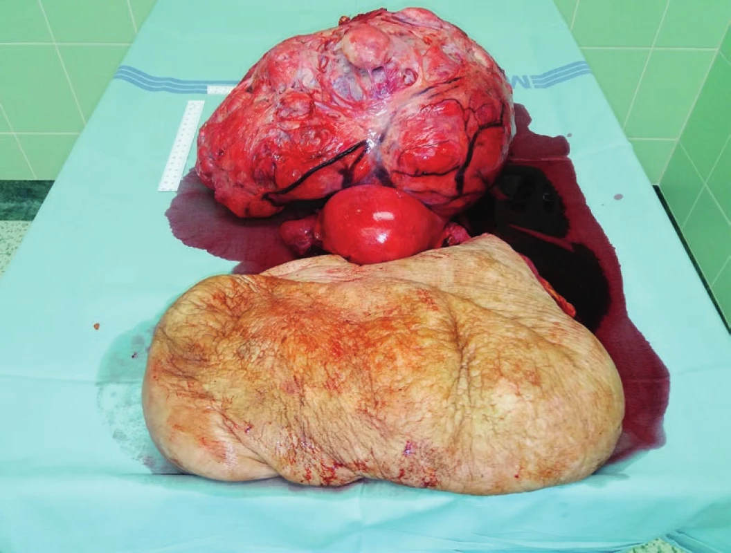 Děloha s objemným tumorem a resekovaný kýlní vak