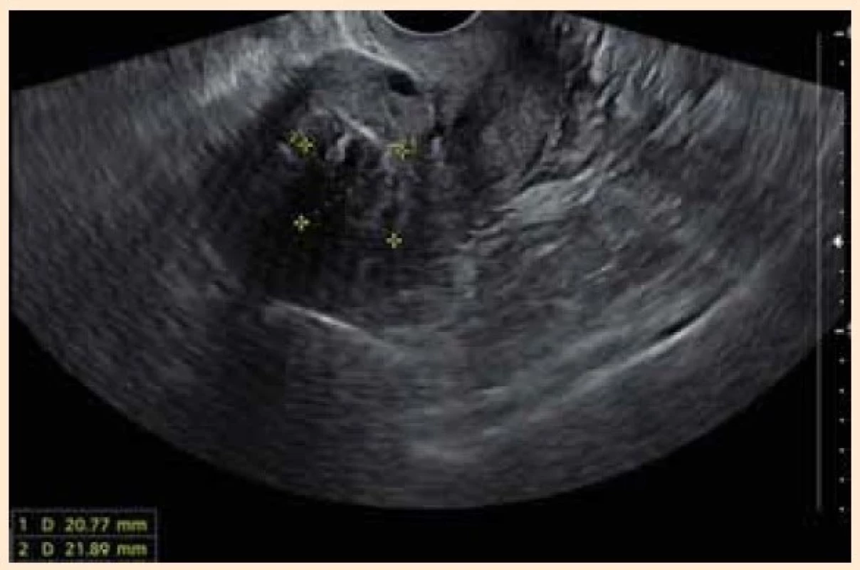 Fig. 2. Sagittal sonographic view of the uterus with a decreased
size of the leiomyoma after treatment with Relugolix
add-back therapy.<br>
Obr. 2. Sagitální sonografické zobrazení dělohy se
zmenšenou velikostí myomu po terapii Relugolixem
s kombinovanou terapií.