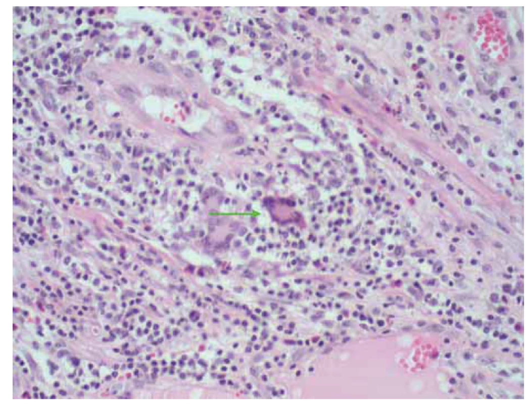 Histopatologický preparát, šipka – Langhansova buňka.<br>
Fig. 1. Histopathological tissue section, arrow – Langhans cell.