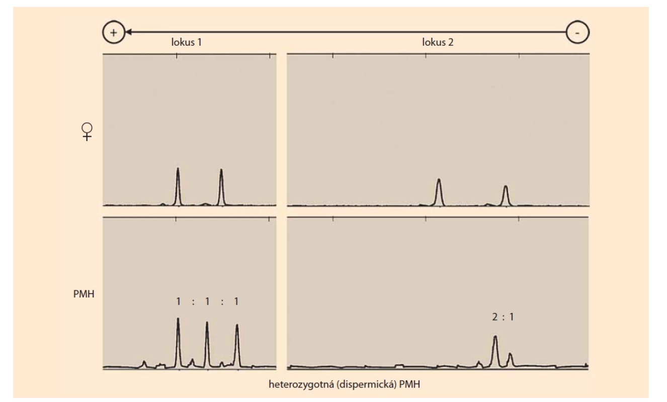 Výsledky genotypizácie krátkych tandemových opakovaní (multiplexná polymerázová reťazová reakcia s fluoresenčne
značenými primermi) heterozygotnej (dispermickej) PMH na základe porovnania genotypov (alel) matky (♀) a choriových 
klkov (PMH). PMH má v uvedených dvoch analyzovaných lokusoch jednu maternálnu alelu a dve nonmaternálne
(paternálne) alely. Lokus 1 obsahuje dve rôzne alely paternálneho pôvodu, čo poukazuje na heterozygotnosť PMH. Lokus
2 obsahuje dve rovnaké alely paternálneho pôvodu a jednu alelu maternálneho pôvodu (zdroj: Ústav lekárskej biológie,
genetiky a klinickej genetiky, Lekárskej fakulty Univerzity Komenského a Univerzitnej nemocnice Bratislava).
PMH – parciálna mola hydatidóza<br>
Fig. 1. Results of the short tandem repeats genotyping (multiplex polymerase chain reaction with fluorescently labeled
primers) of heterozygous (dispermic) PMH based on a comparison of maternal (♀) and chorionic villus (PMH) genotypes
(alleles). PMH has one maternal allele and two non-maternal (paternal) alleles in the two analyzed loci. Locus 1 contains two
different alleles of paternal origin, indicating the heterozygosity of PMH. Locus 2 contains two identical alleles of paternal origin
and one allele of maternal origin (source: Institute of Medical Biology, Genetics and Clinical Genetics, Faculty of Medicine,
Comenius University in Bratislava).