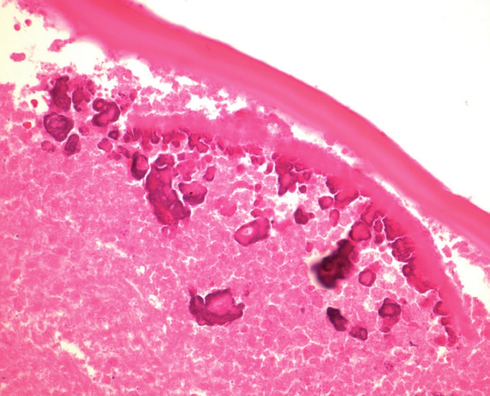 Histopatologie: lamelární struktura echinokokové cysty, vnitřní okraj cysty s dystrofickou kalcifikací; barvení HE, zvětšení 400krát