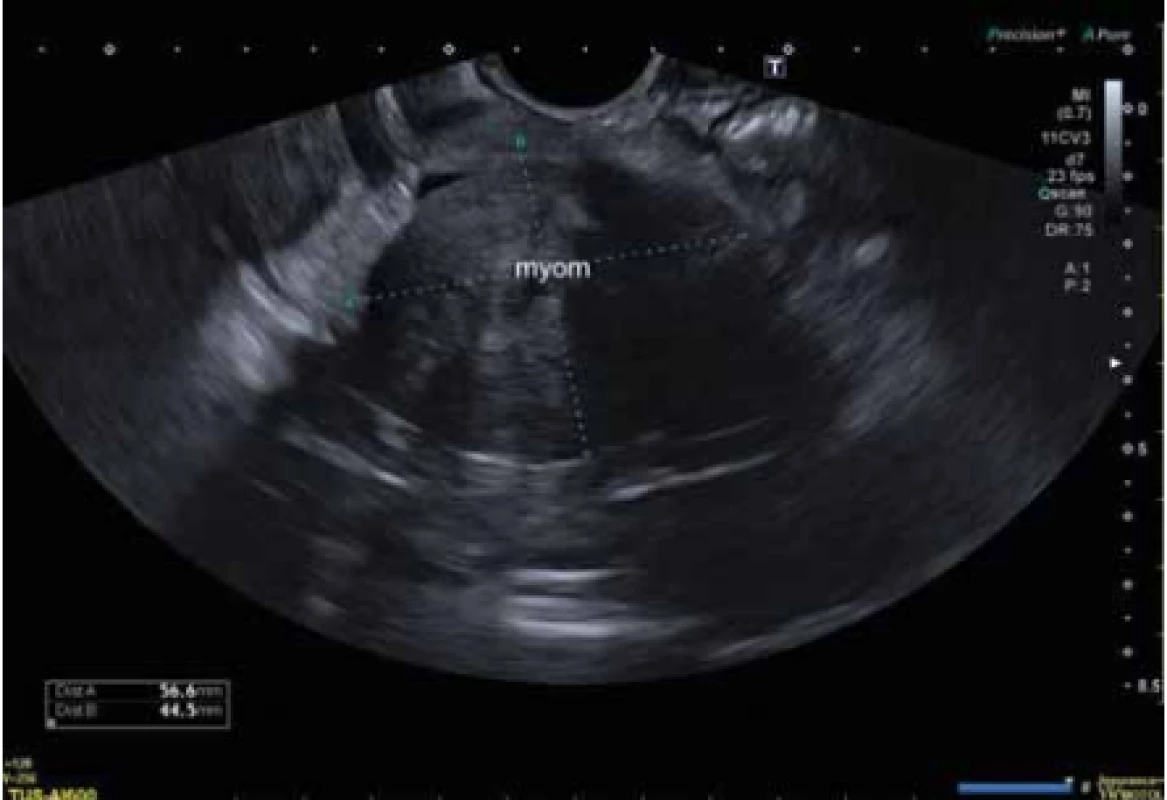 Ultrazvukové vyšetření před operací, hypoechogenní tumor malé 
pánve velikosti 56 × 44 × 74 mm.<br>
Fig. 1. Ultrasound examination before surgery, hypoechogenic tumor of the small 
pelvis, size 56 × 44 × 74 mm. 