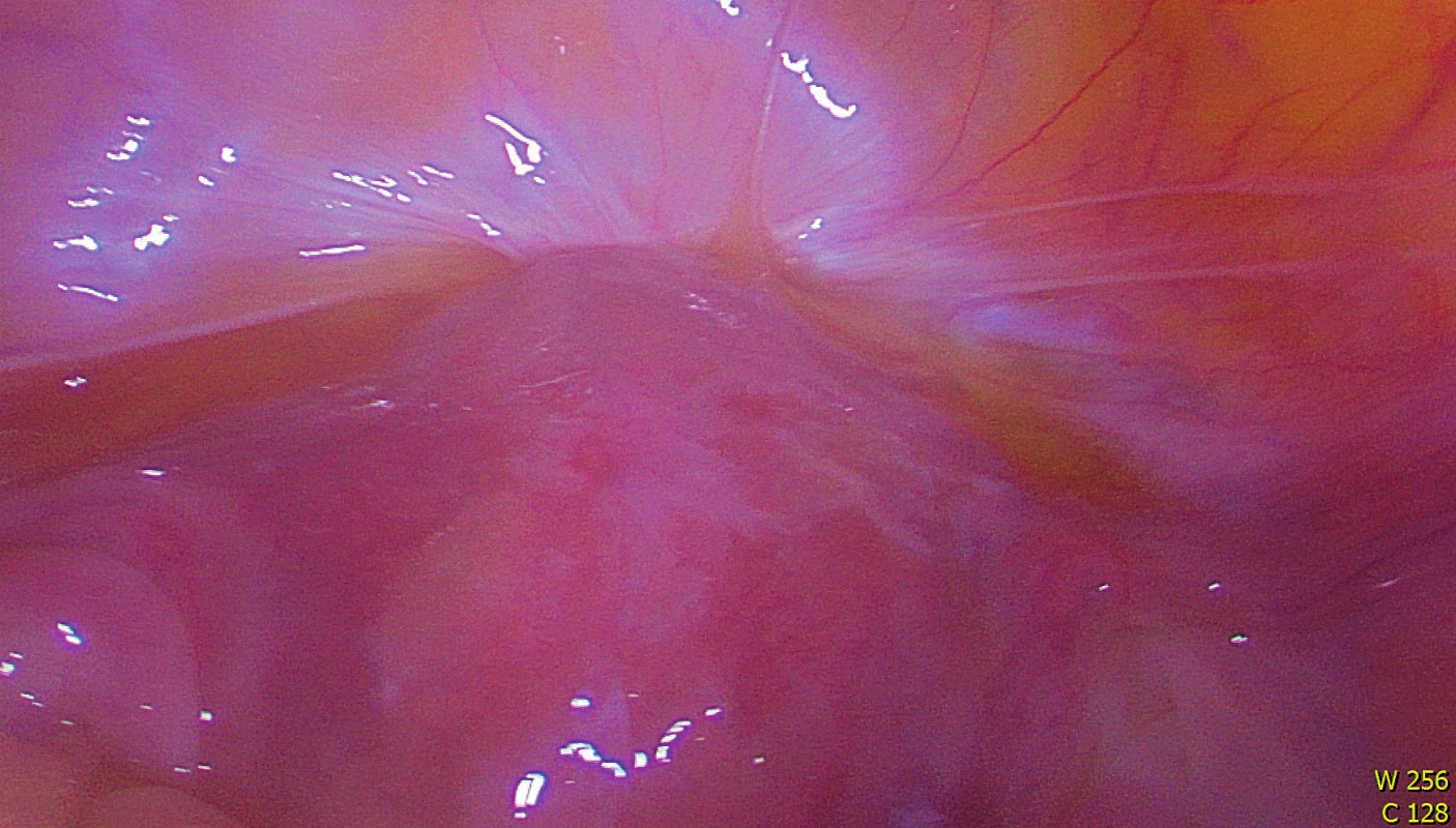 Peroperační nález před výkonem (defekt v děložním istmu, vpáčená plika močového měchýře)